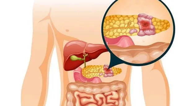 10 Cara Mendeteksi Masalah Pankreas Sejak Dini